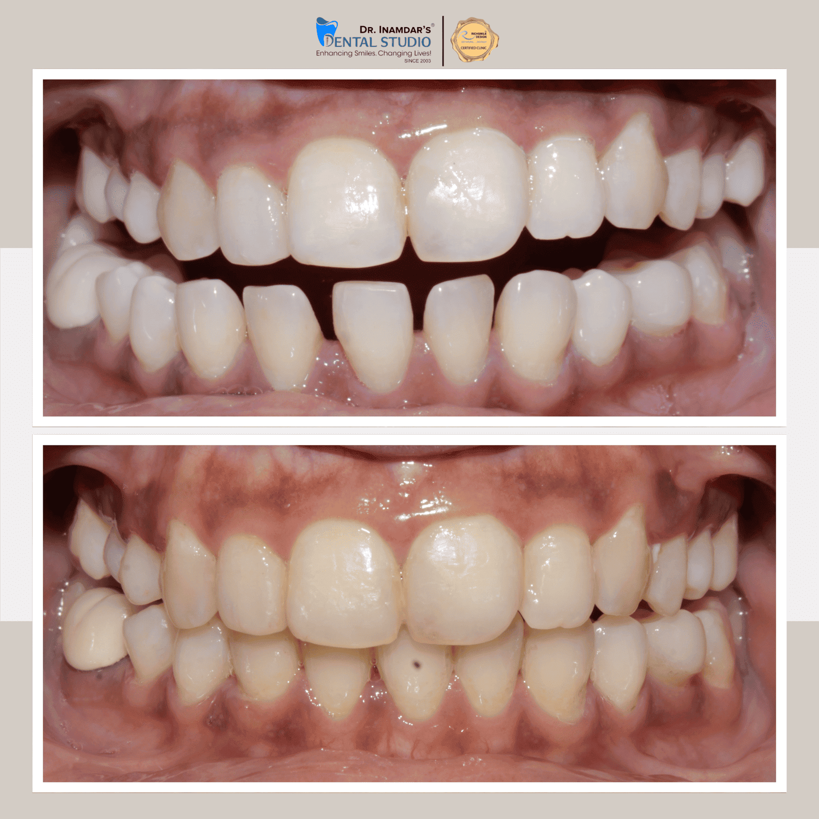 Aligners Case 2