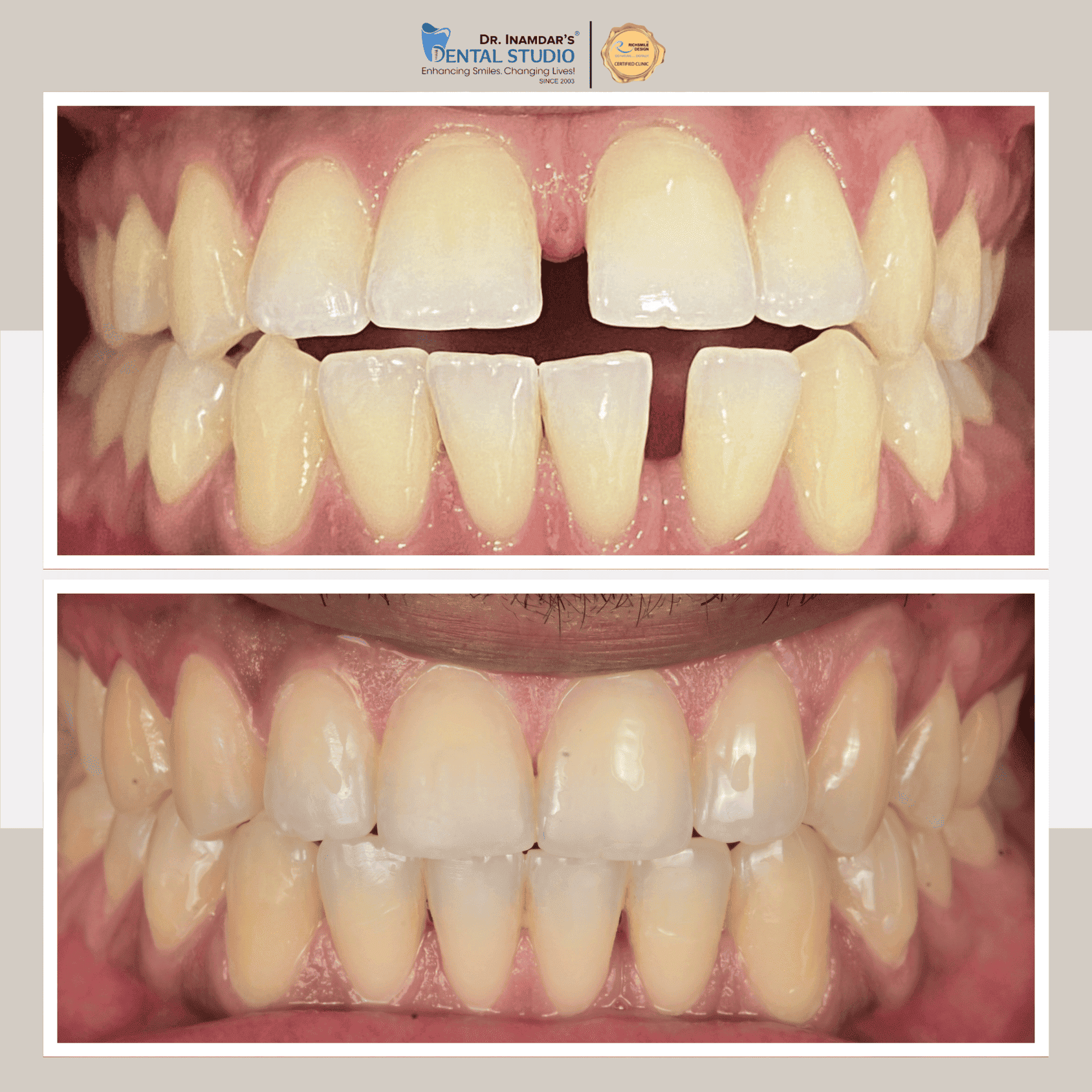 Aligners Case 3