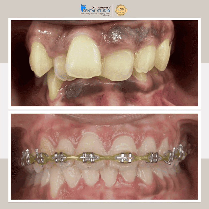 Braces Case 1