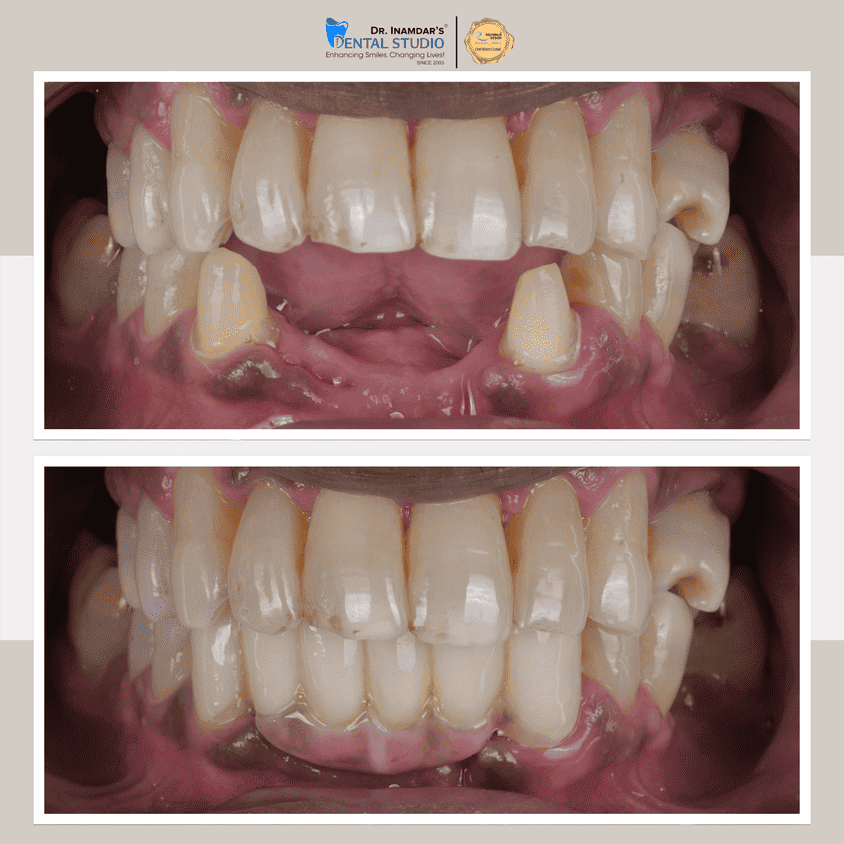 Crowns & Bridges Case 1