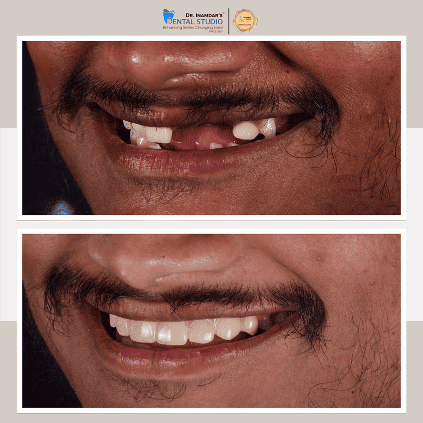 Crowns & Bridges Case 2