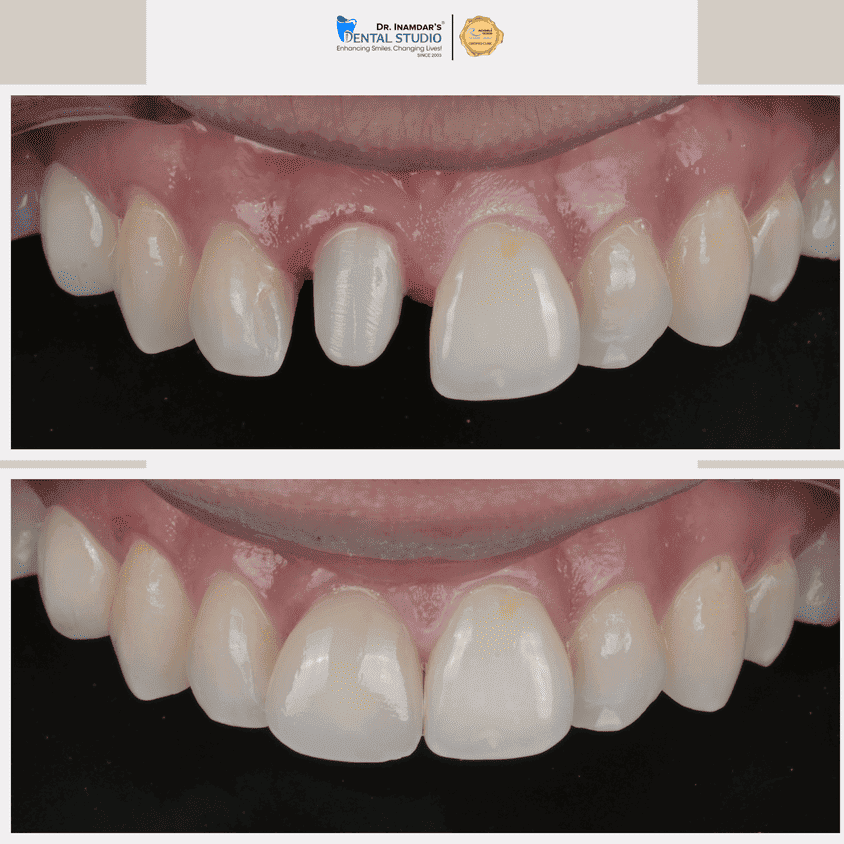 Crowns & Bridges Case 3