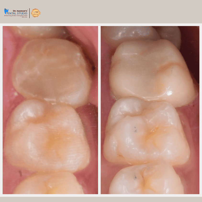 Crowns & Bridges Case 4