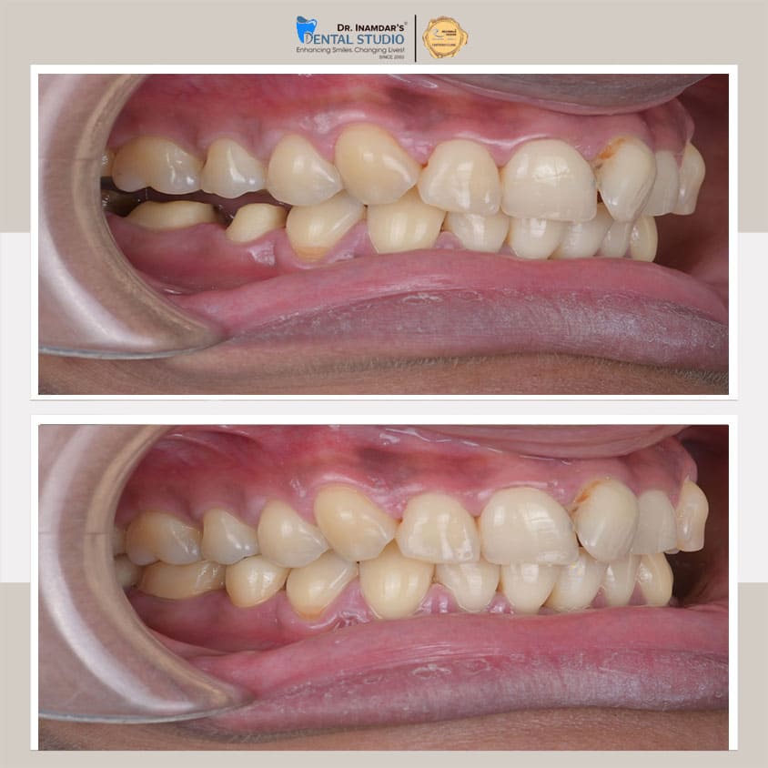 Crowns & Bridges Case 5
