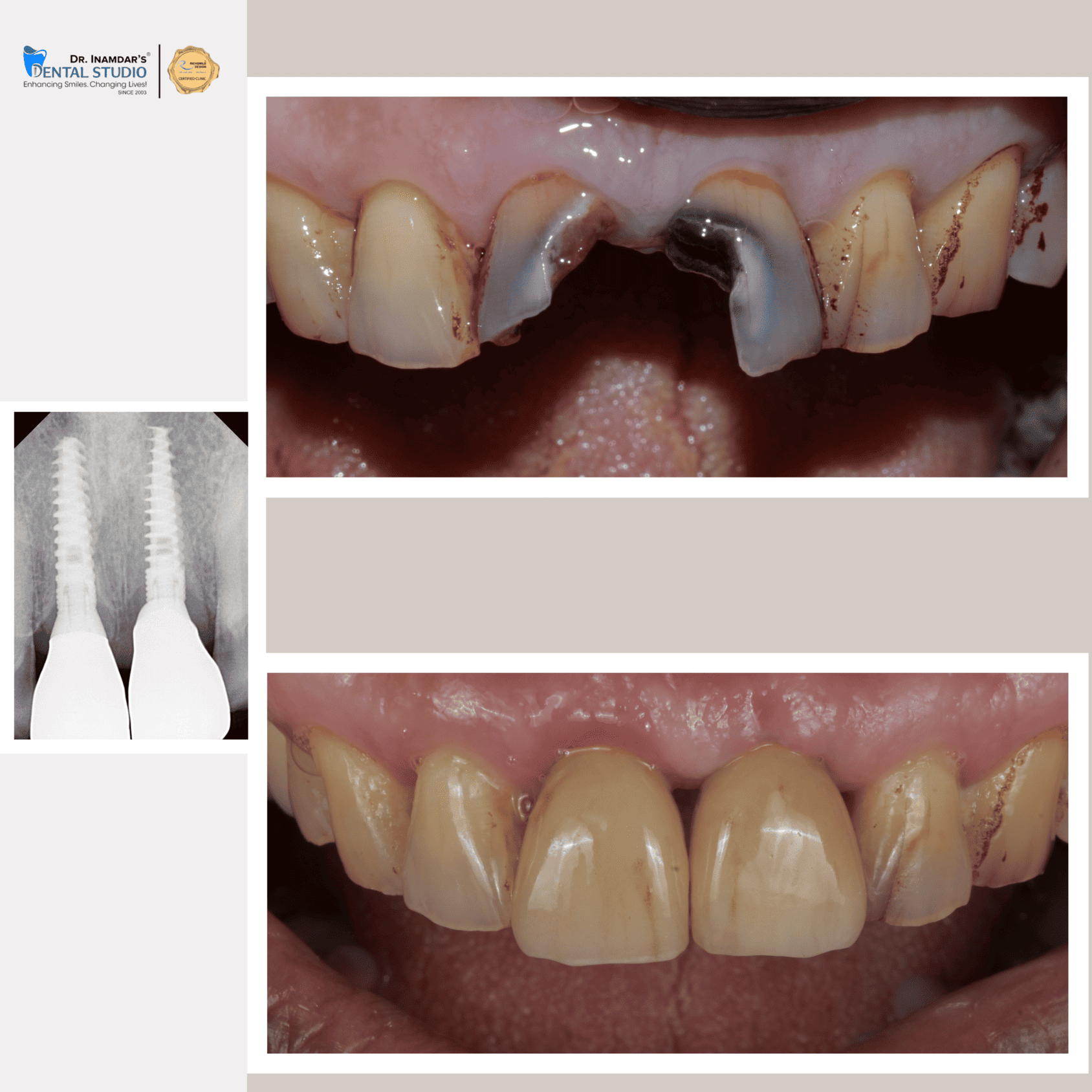 Multiple Implant Case 1
