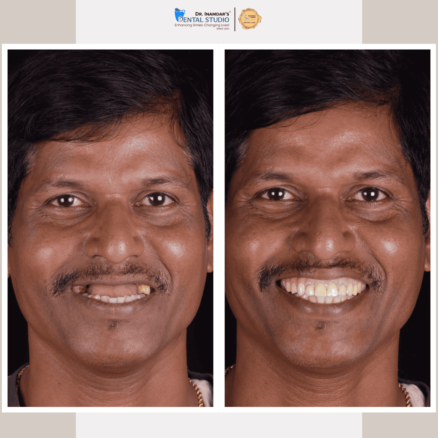 Multiple Implant Case 2