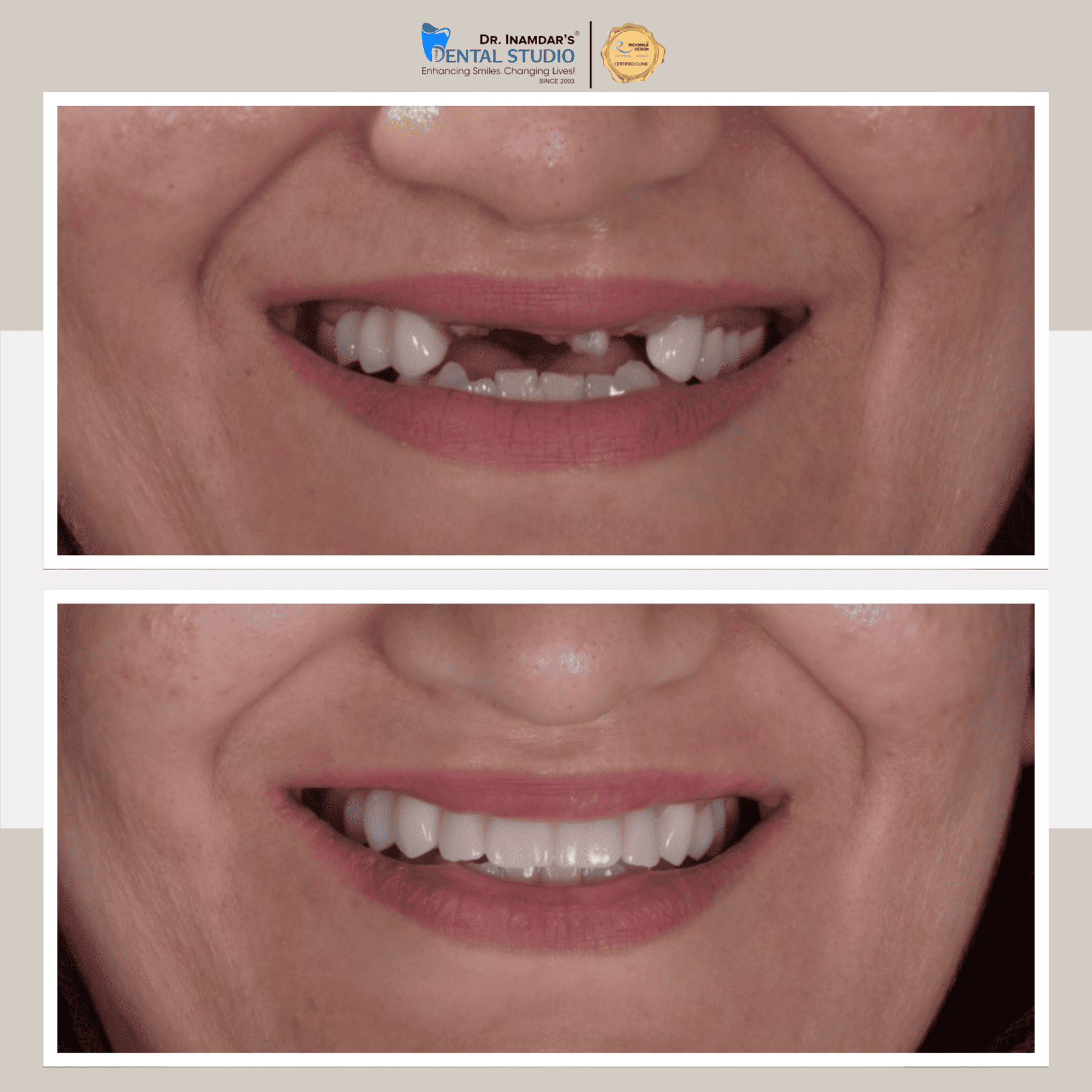 Multiple Implant Case 3