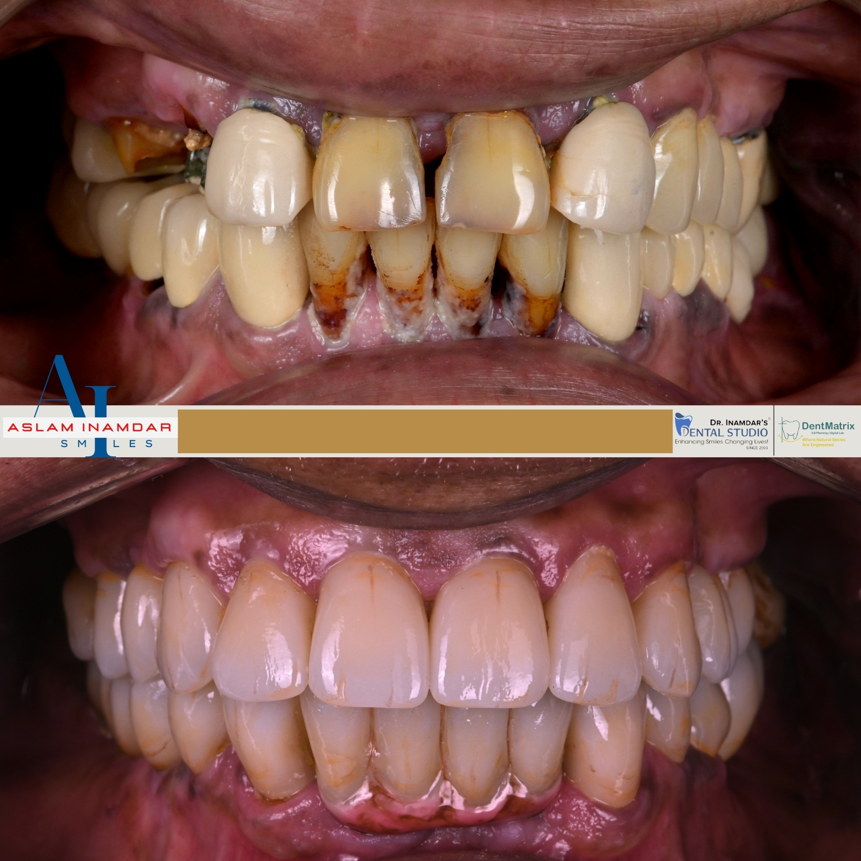 Multiple Implant Case 5