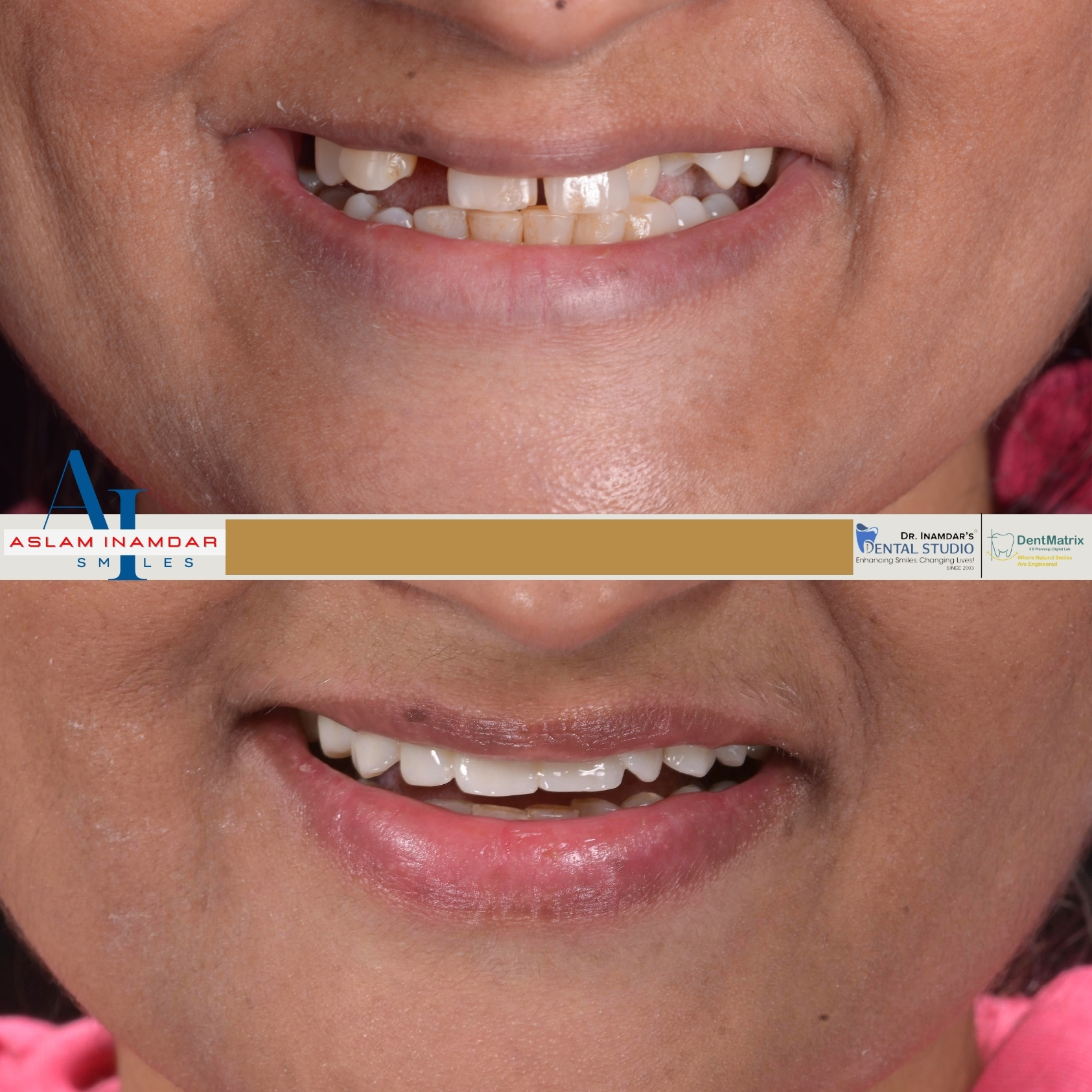 Multiple Implant Case 7