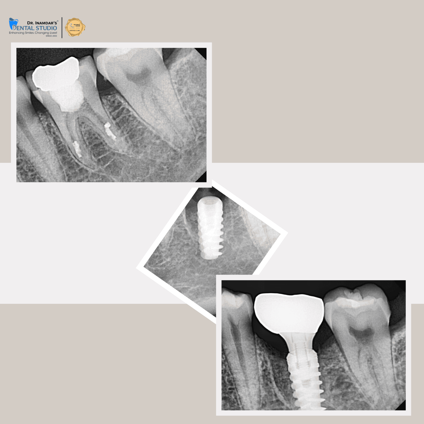 Single Implant Case 1