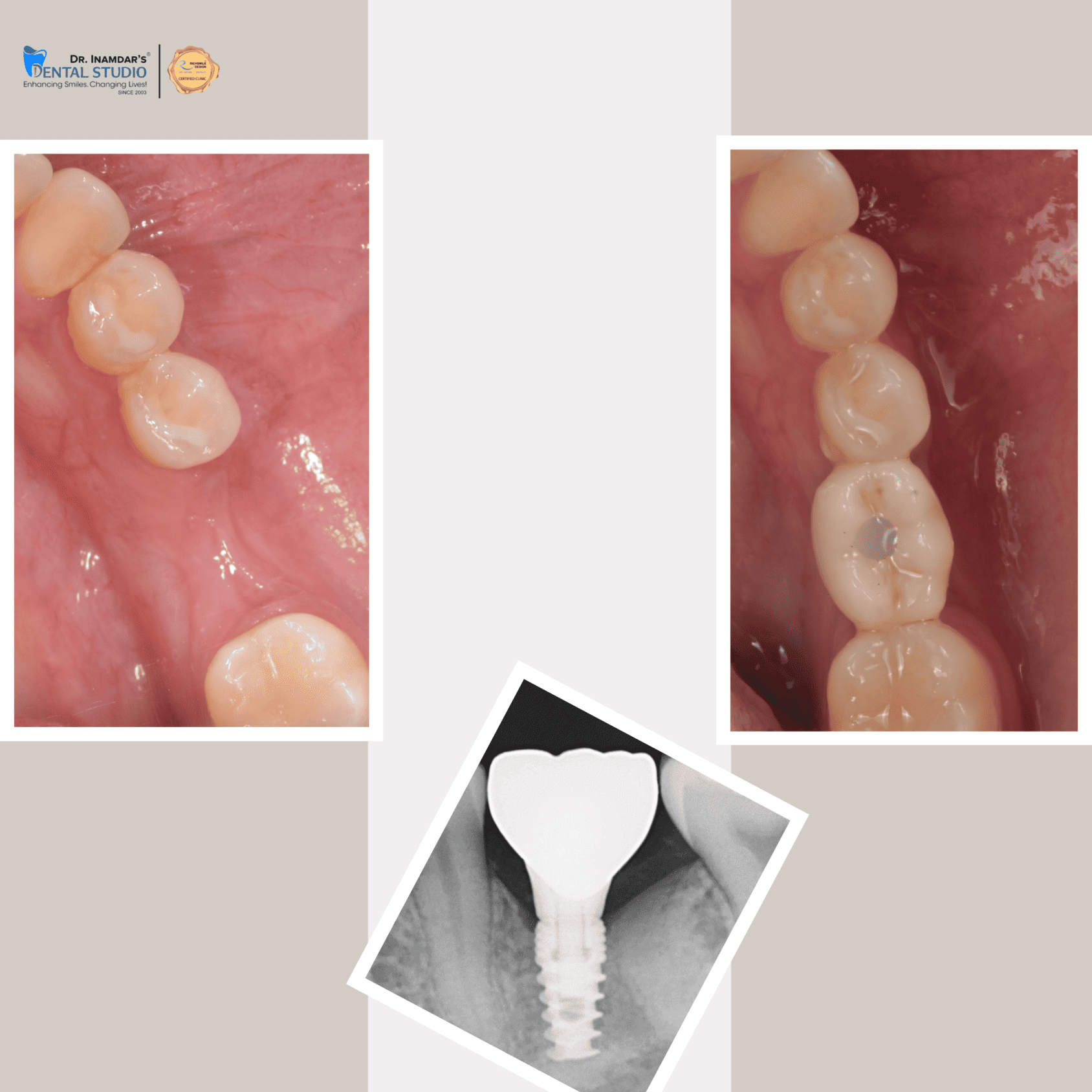 Single Implant Case 2