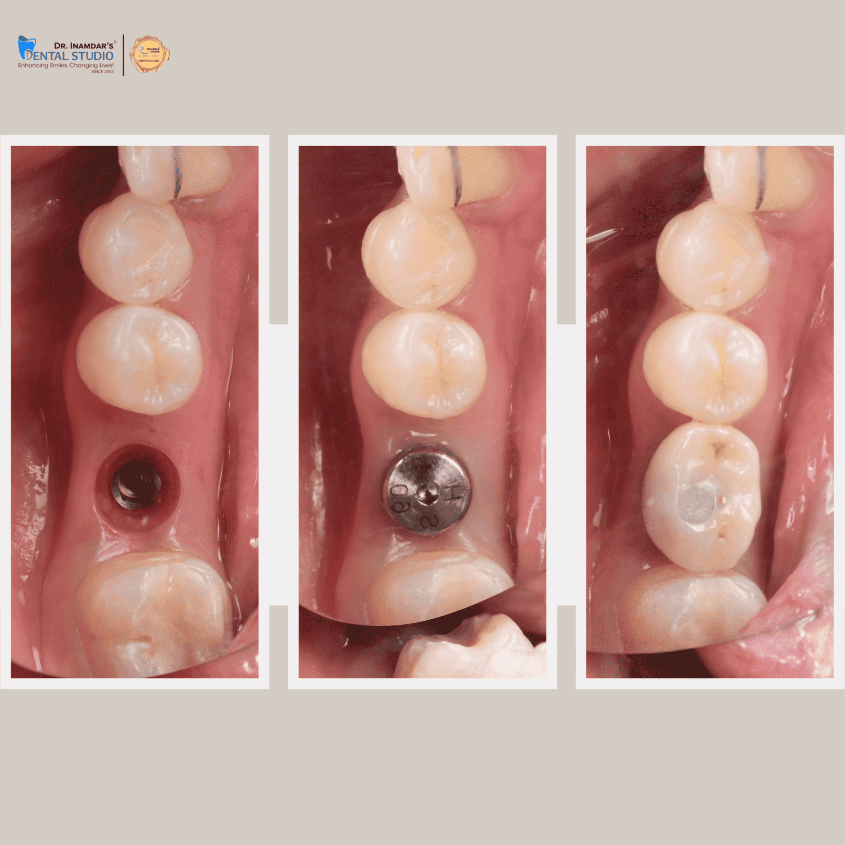 Single Implant Case 3