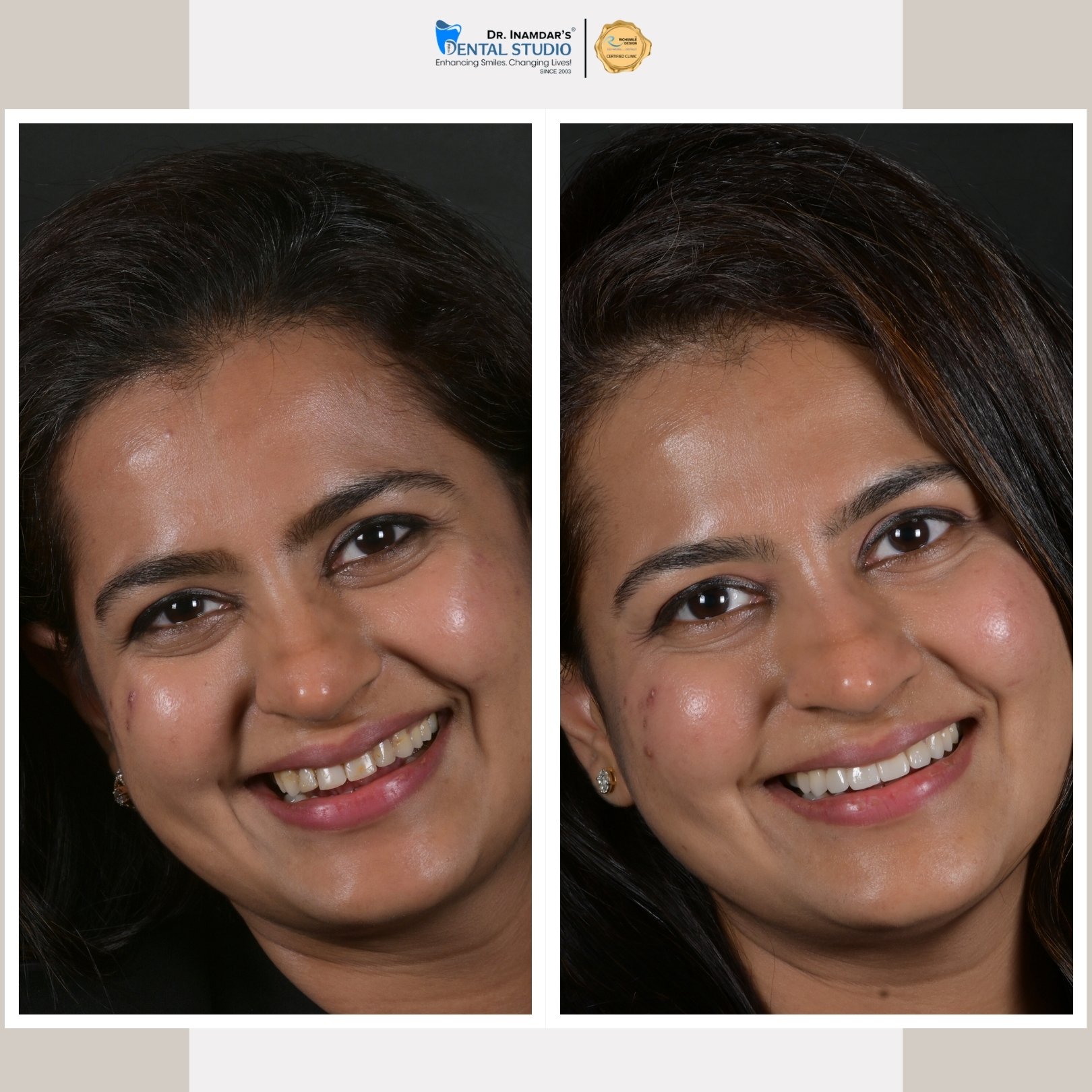 Smile Makeover Case 1