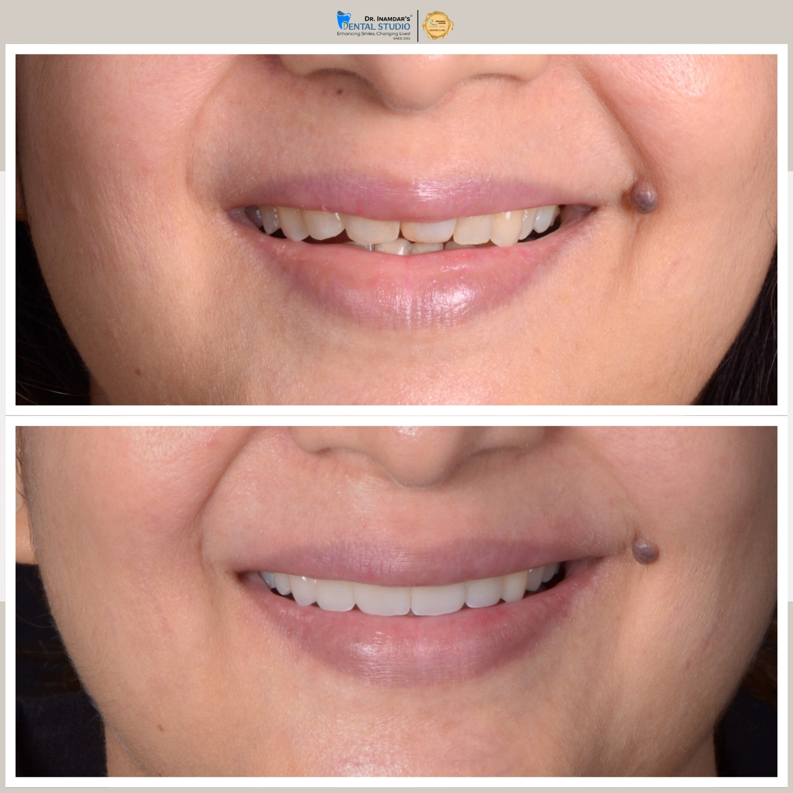 Smile Makeover Case 2