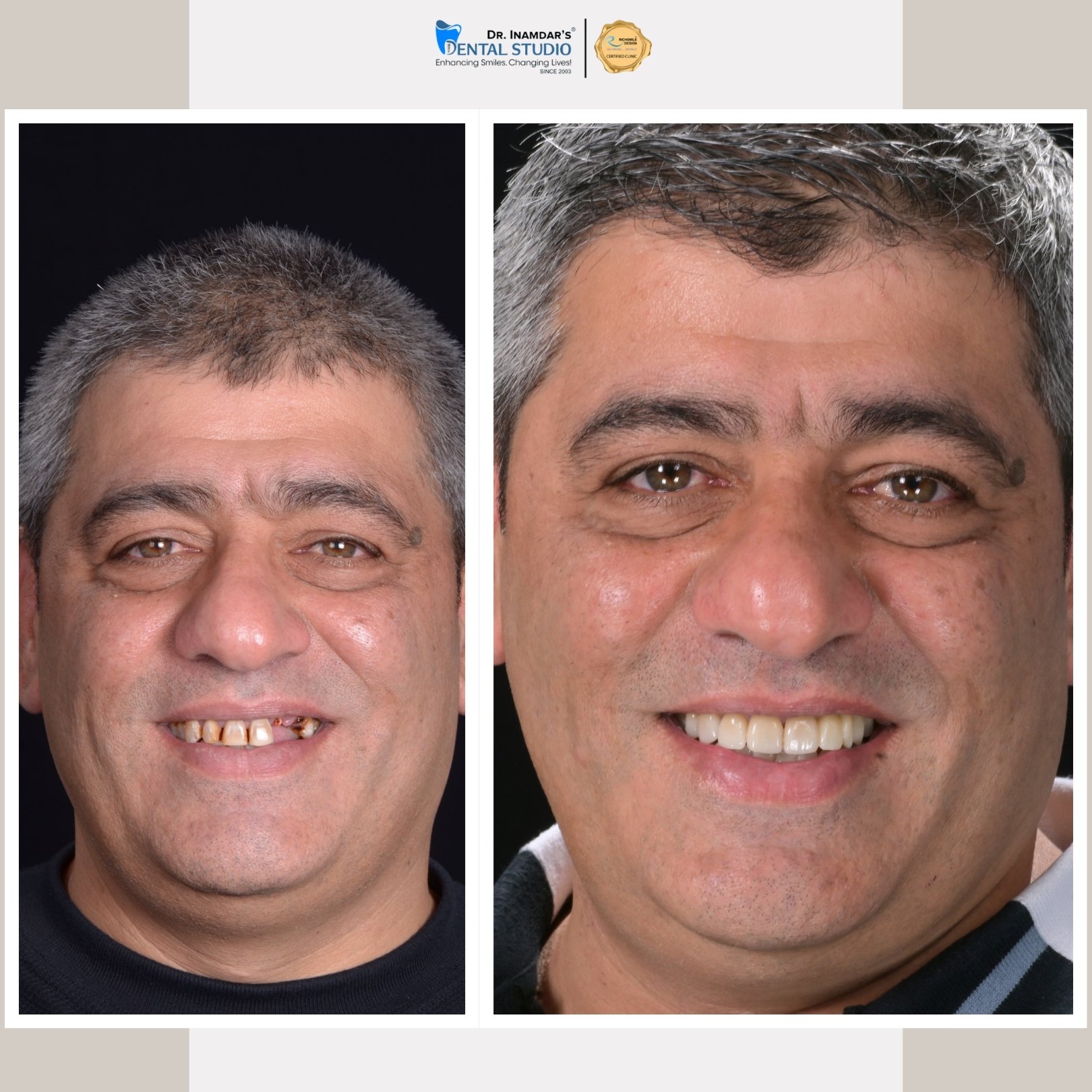 Smile Makeover Case 3