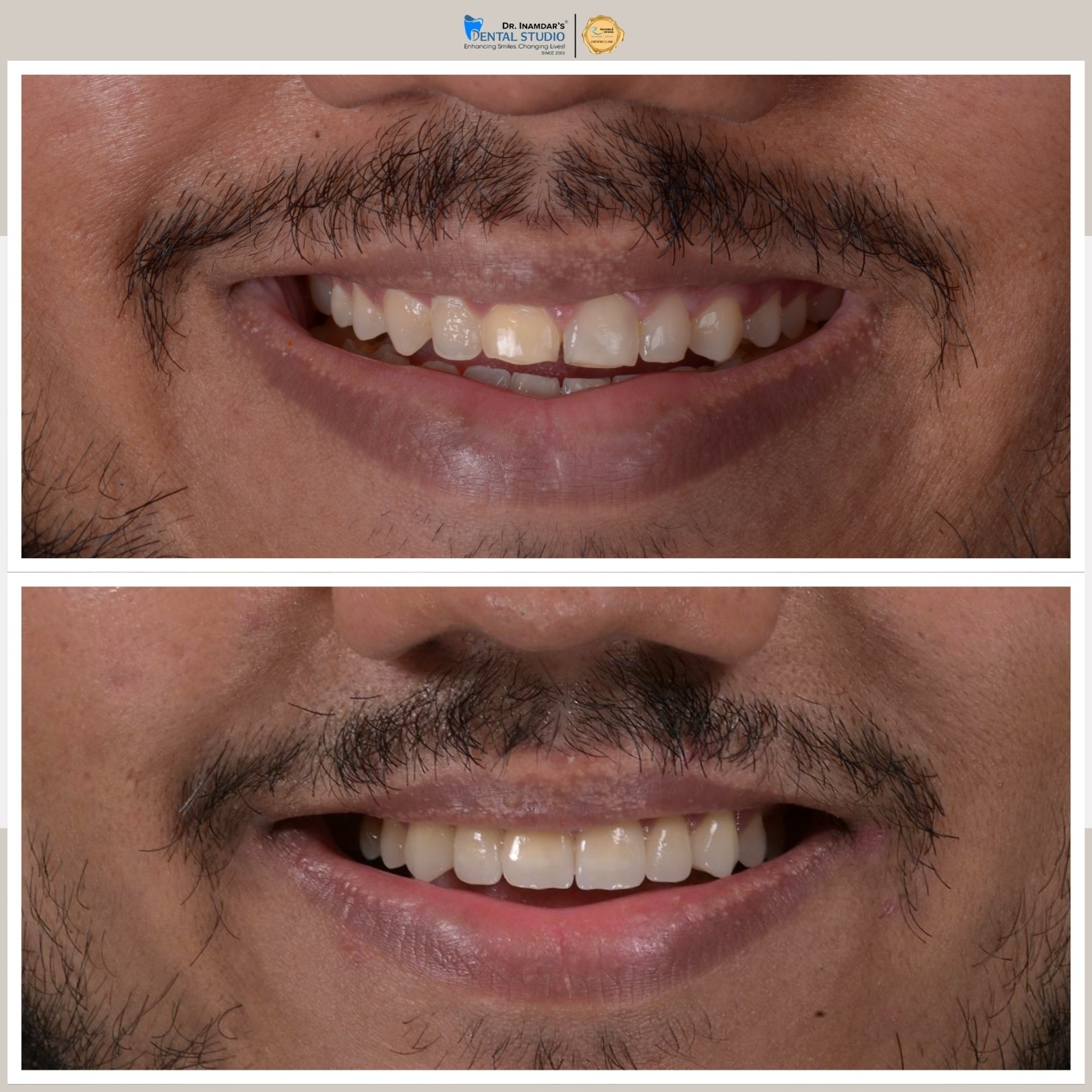 Smile Makeover Case 1