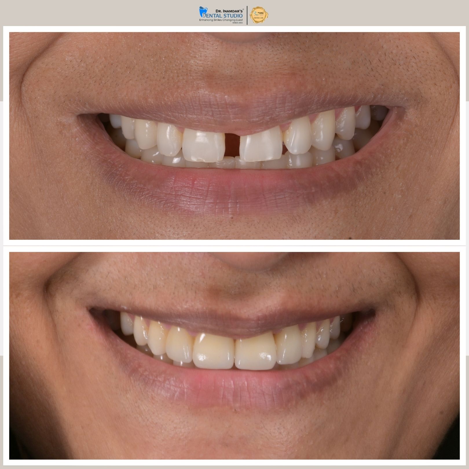 Smile Makeover Case 3