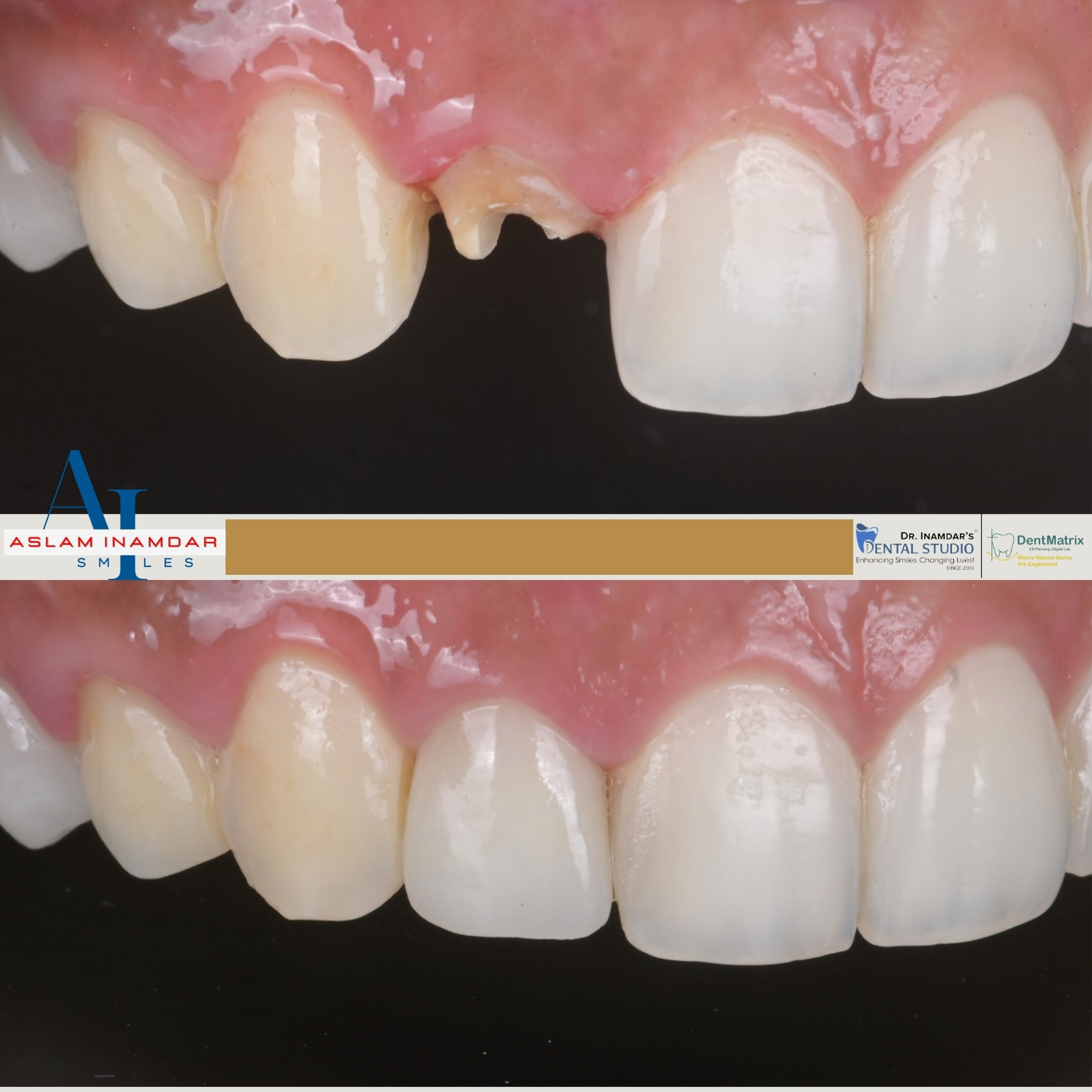 Veneers Case 10