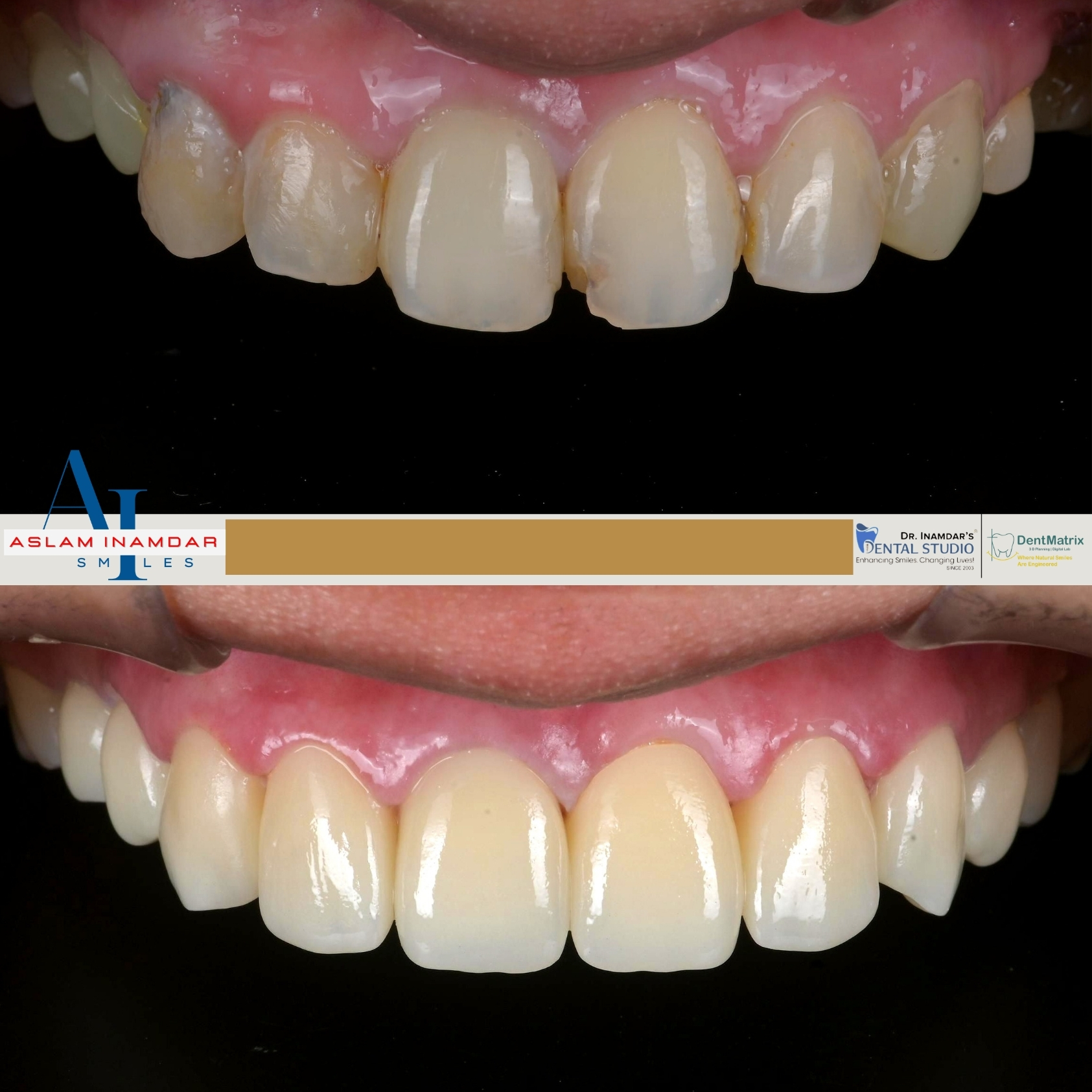 Veneers Case 11