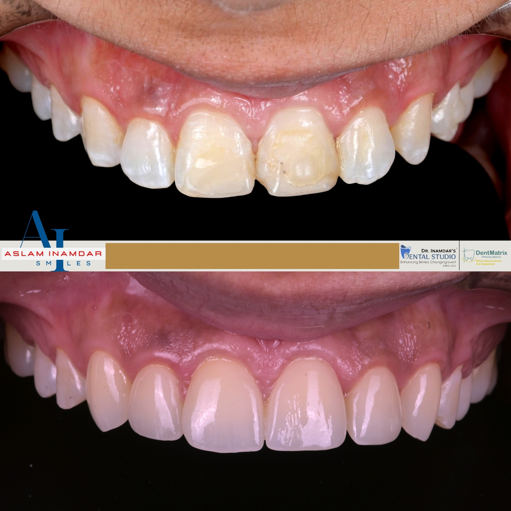Veneers Case 12