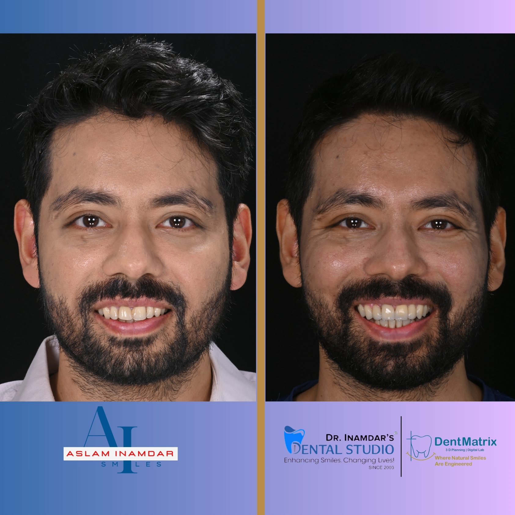 Veneers Case 13