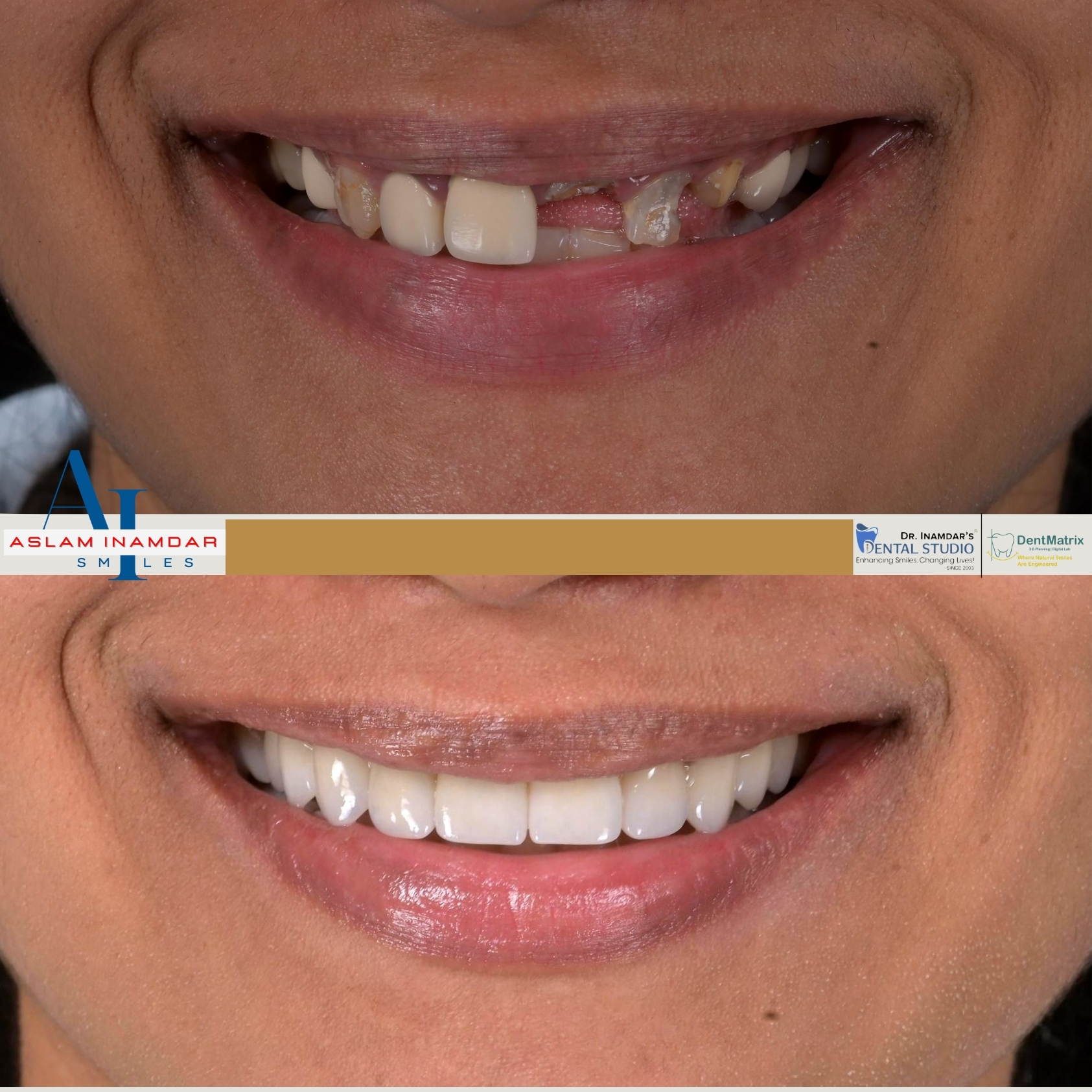 Multiple Implant Case 4
