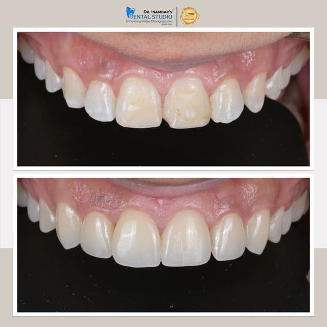 Veneers Case 2