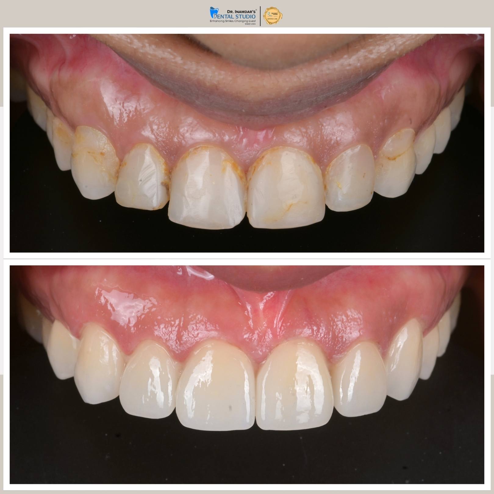 Veneers Case 4