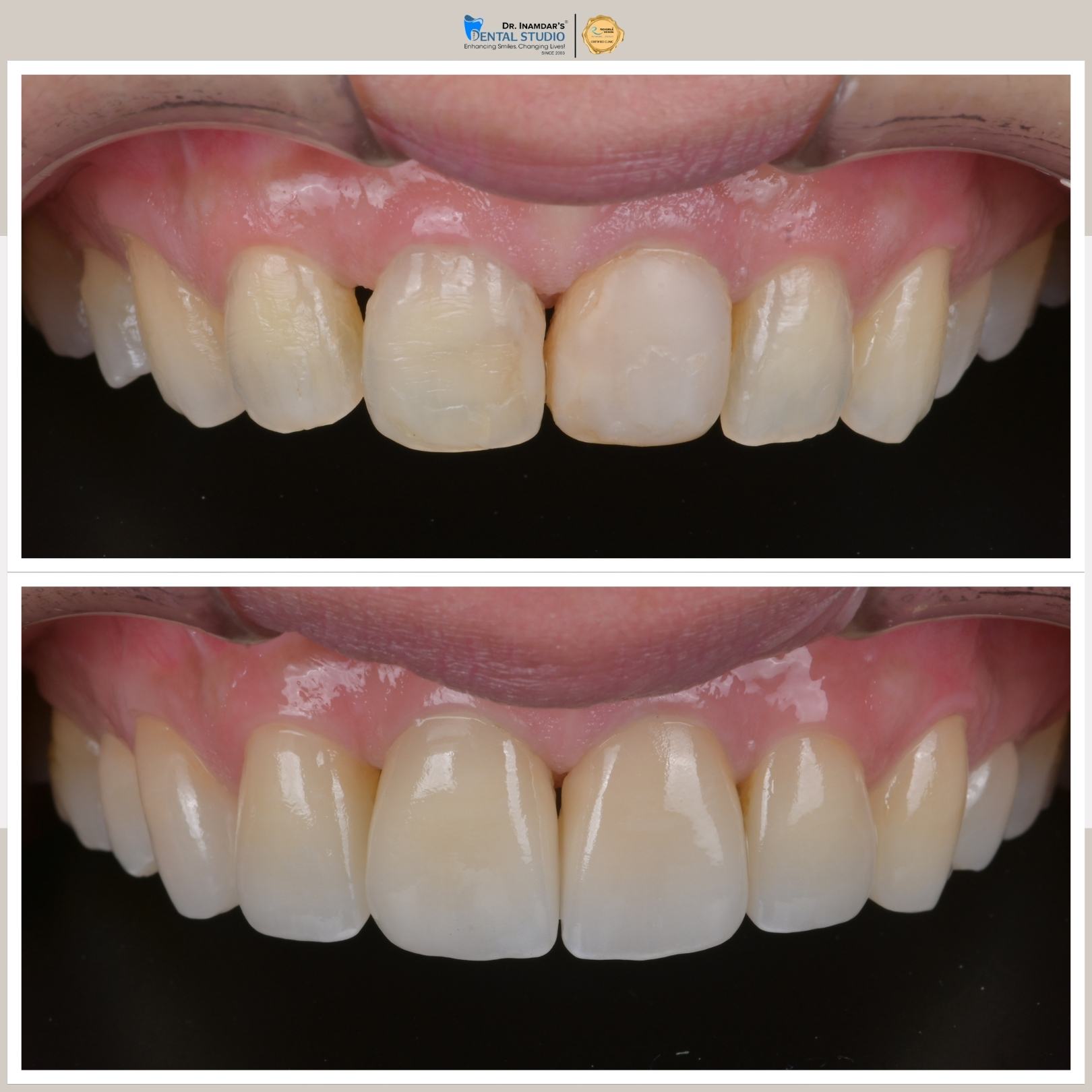 Veneers Case 6