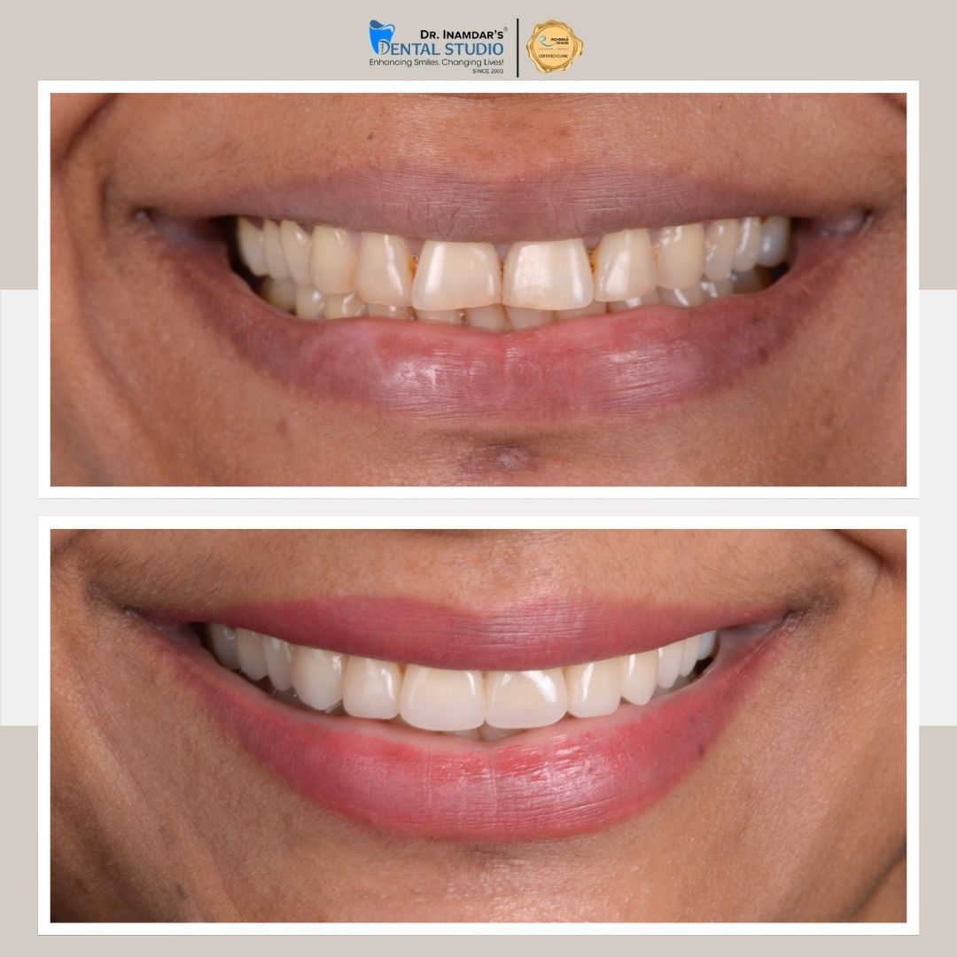 Veneers Case 7