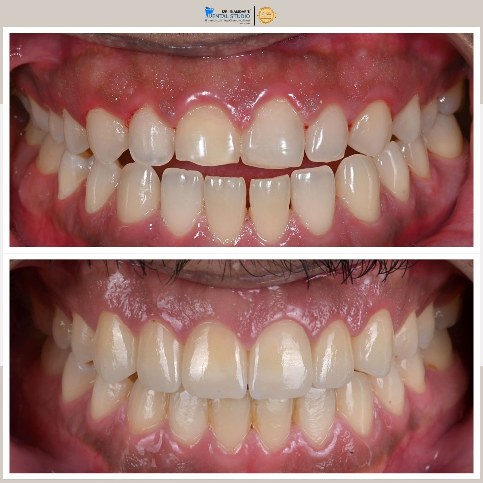 Veneers Case 8