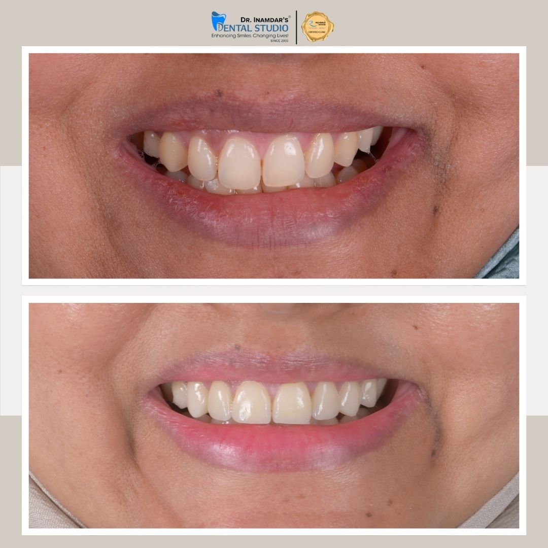 Veneers Case 9