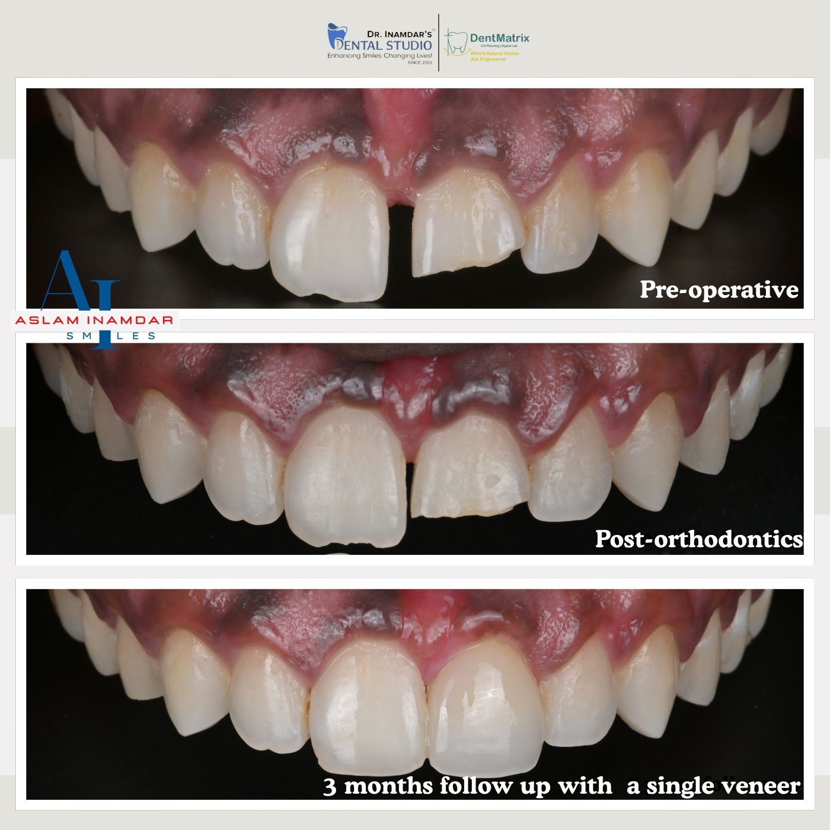 Taher after smile transformation