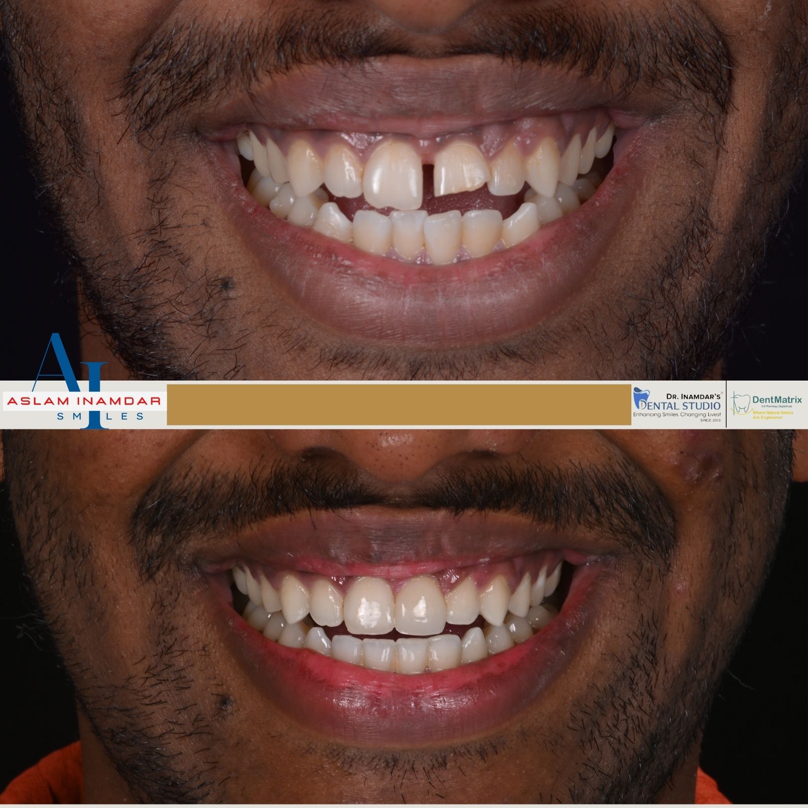 Taher after smile transformation