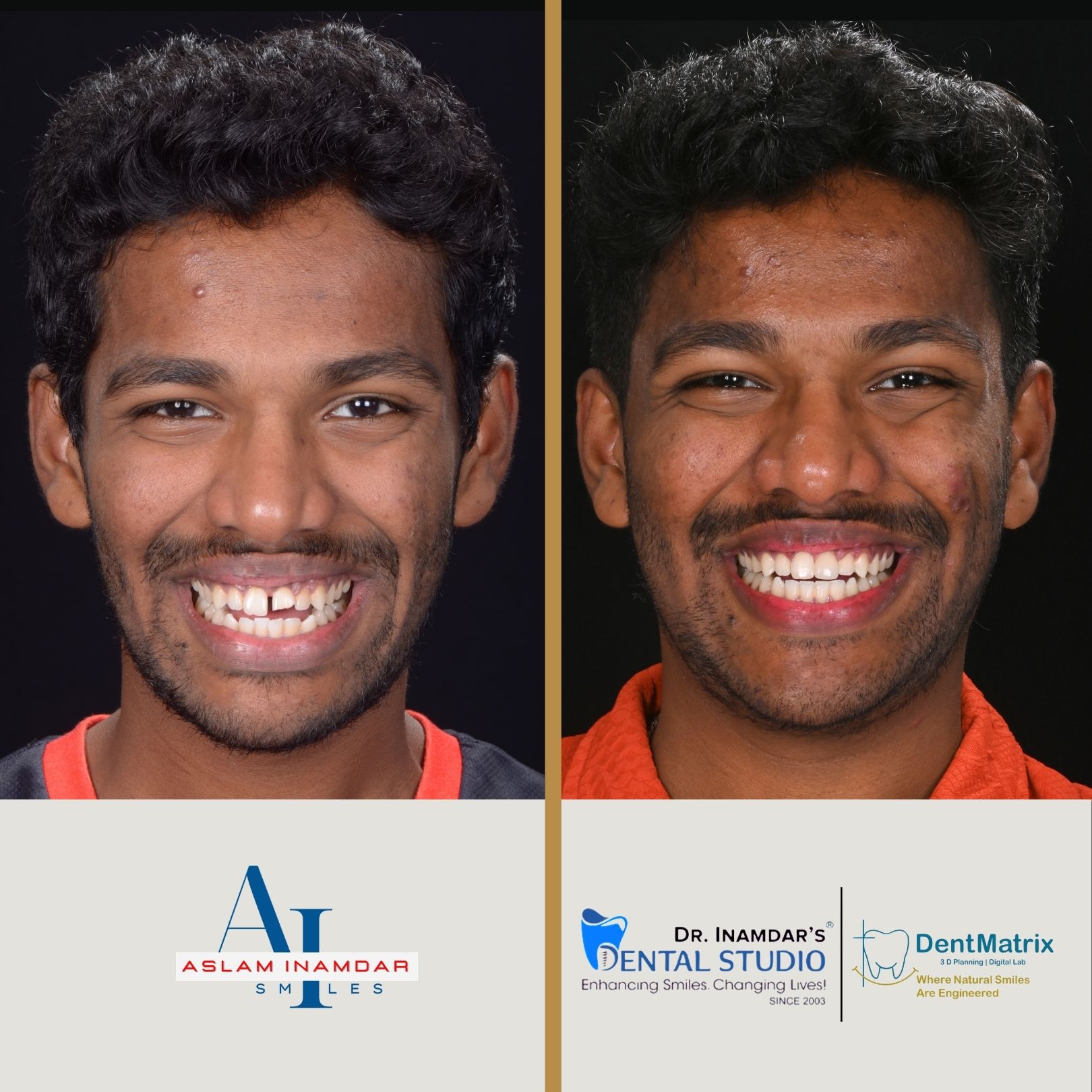 Taher after smile transformation