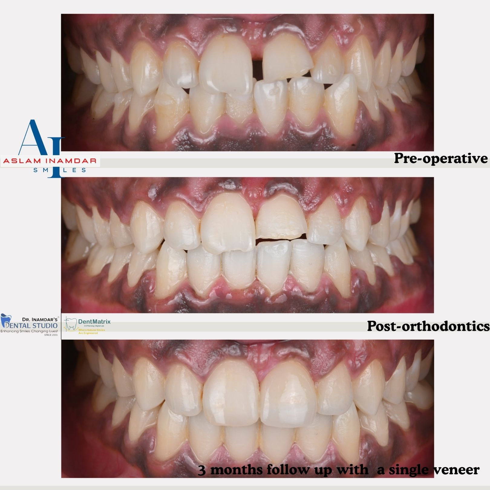 Taher after smile transformation