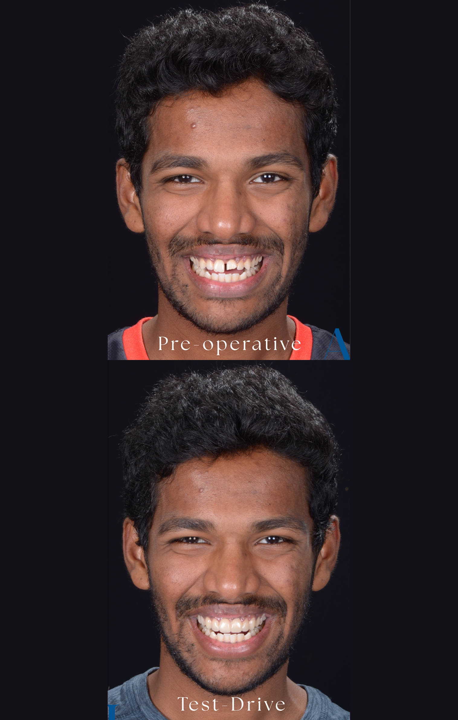 Taher before smile transformation