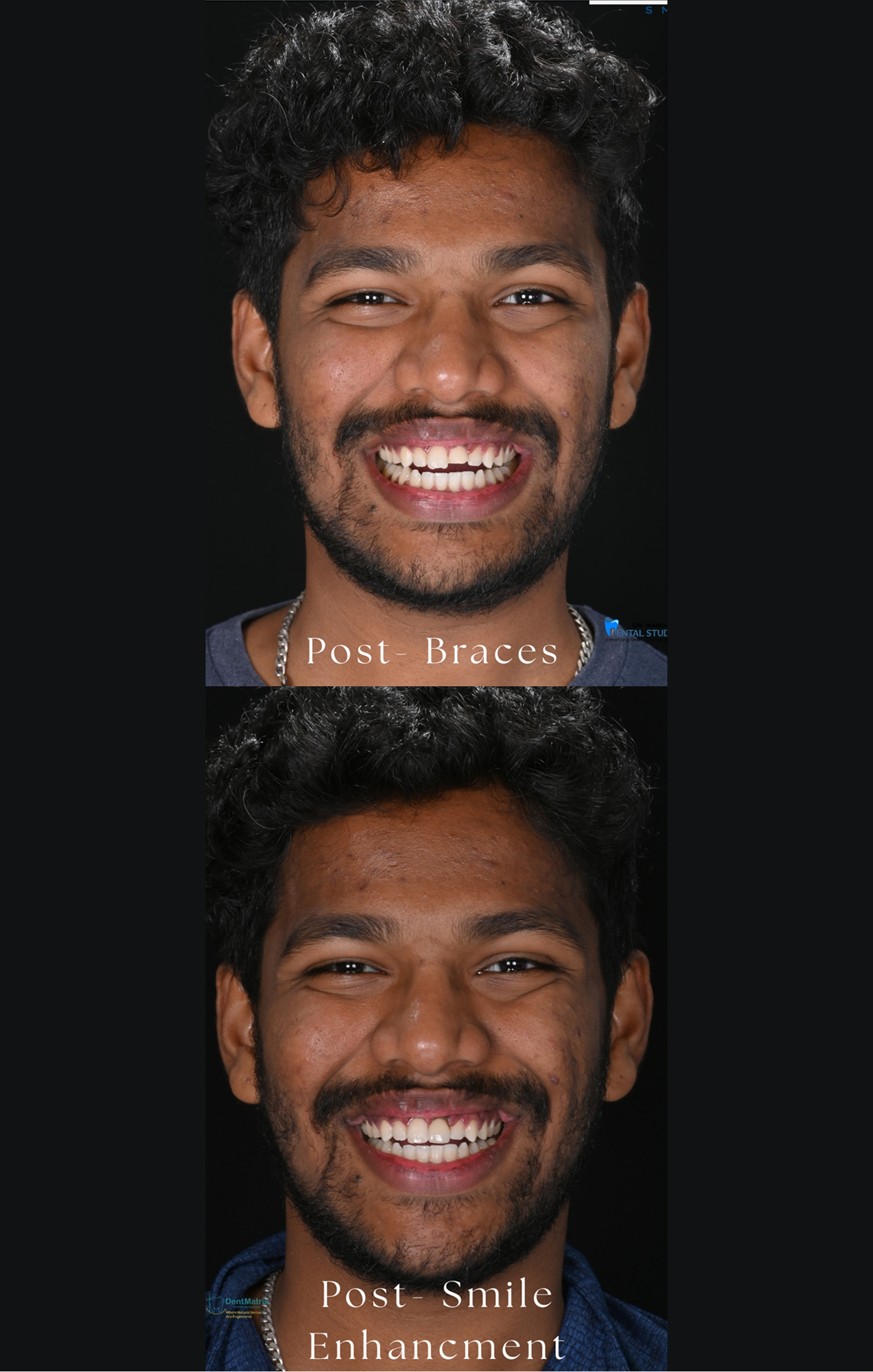 Taher after smile transformation