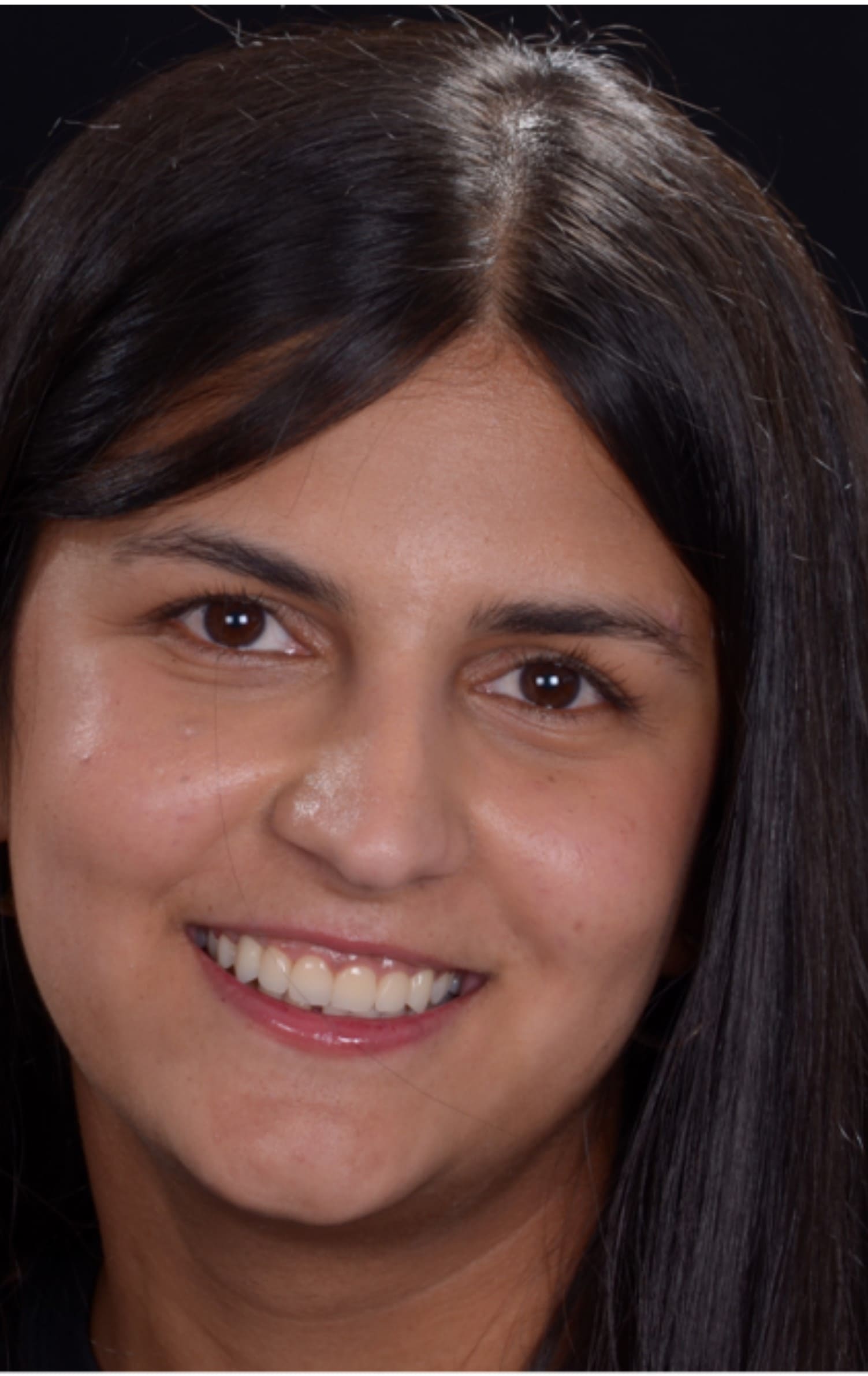 Aish after dental smile fix