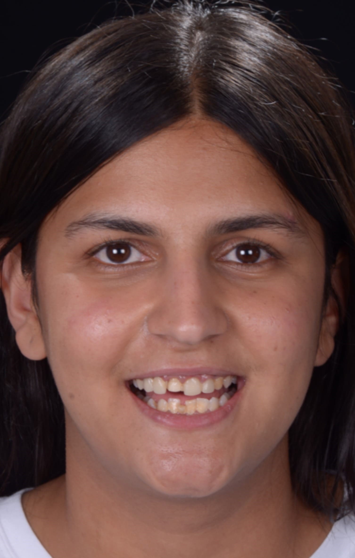 Aish before dental smile fix