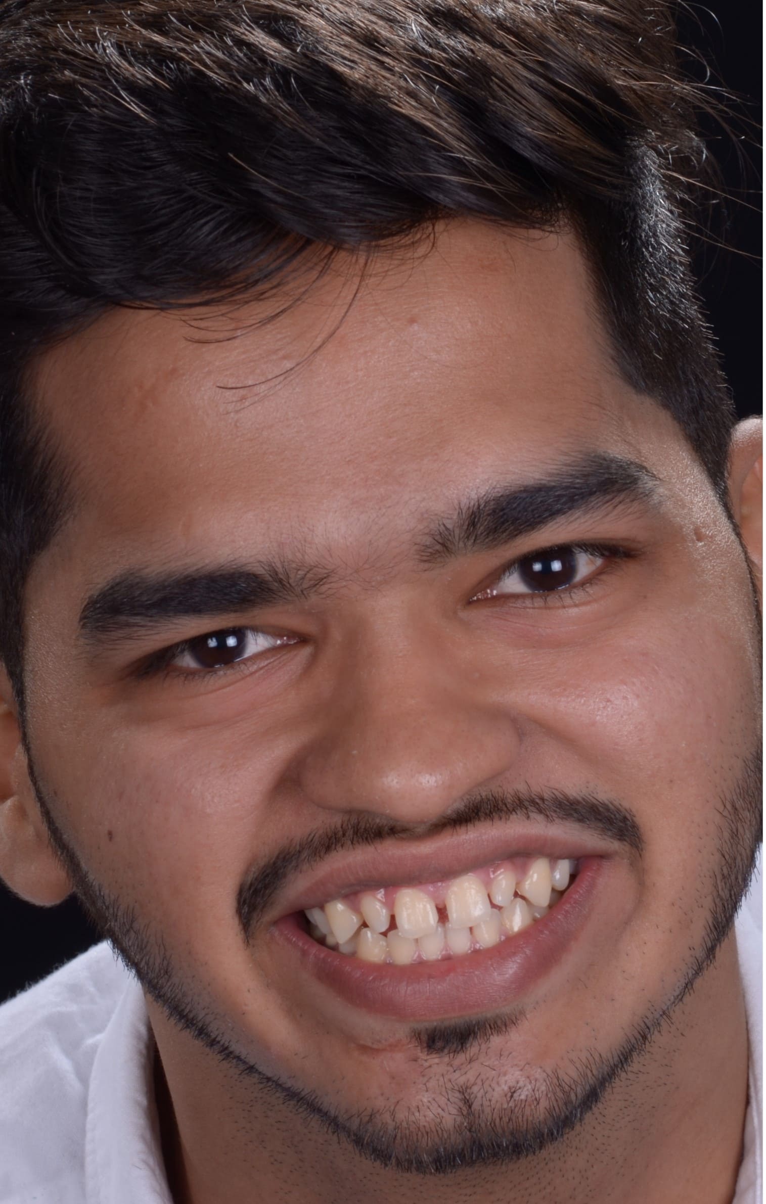 Armaash before smile makeover