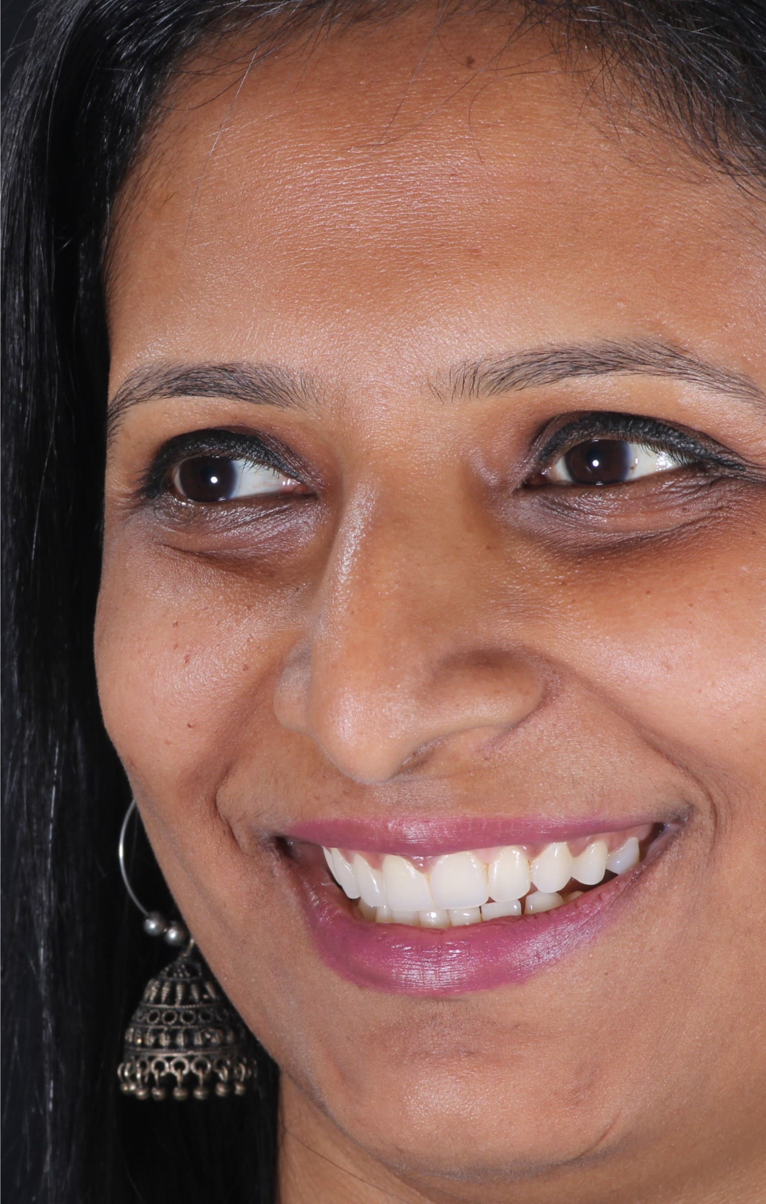 Deepti after smile correction