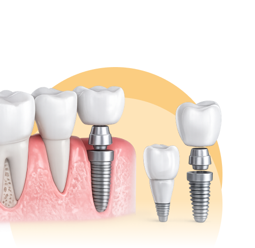 Dental Implants