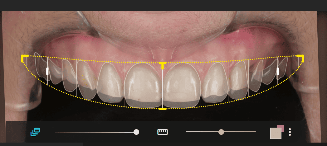 Digital Smile Design process visual