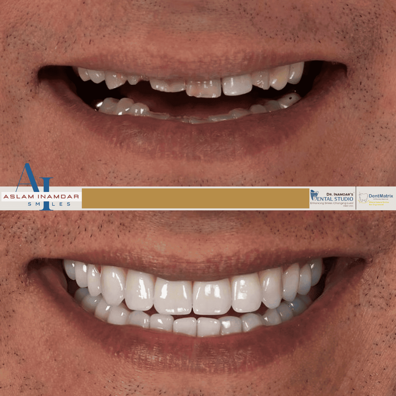 Dental Implant