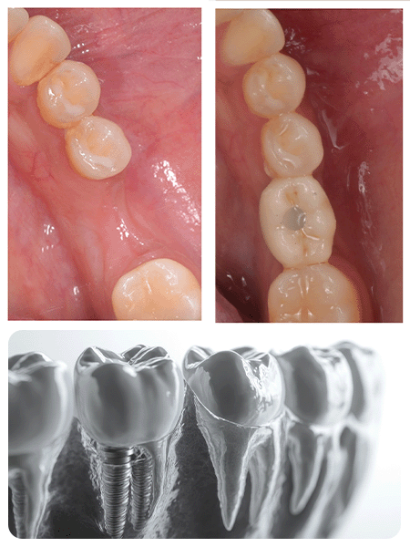 Dental implant procedure illustration