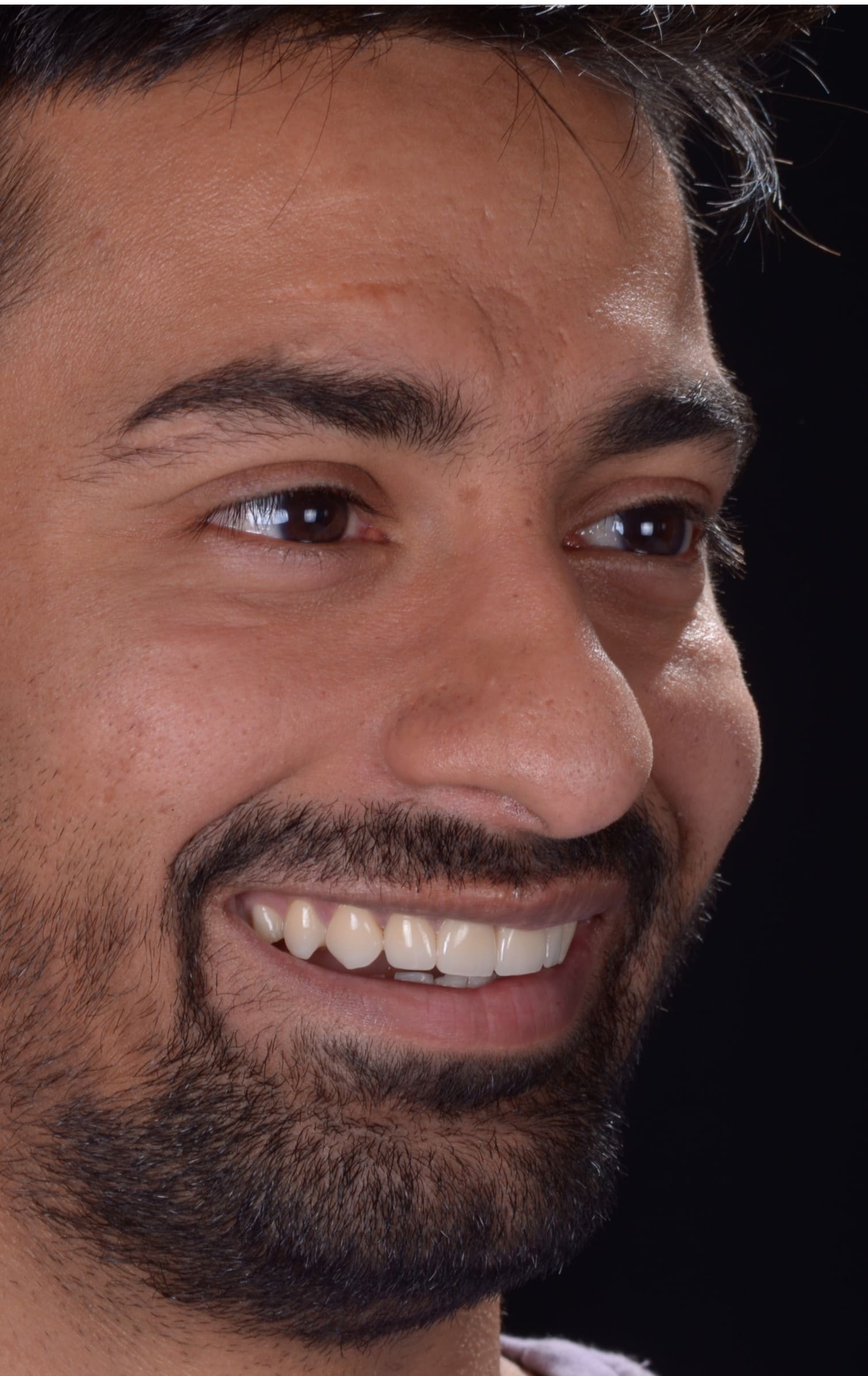 Taher after smile transformation
