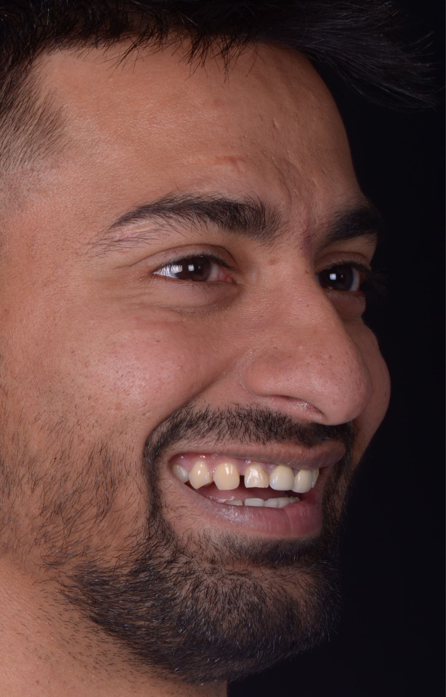 Taher before smile transformation