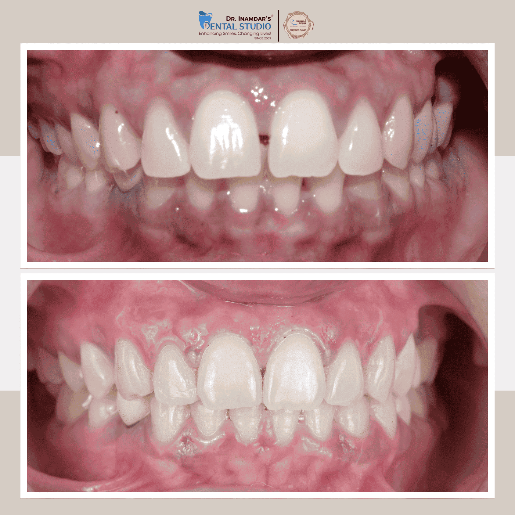 Aligners / Invisalign