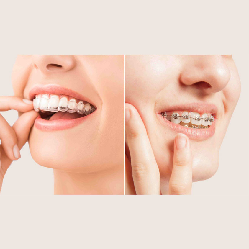 Braces & Aligners